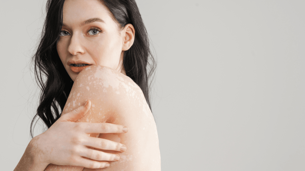 علاج البهاق